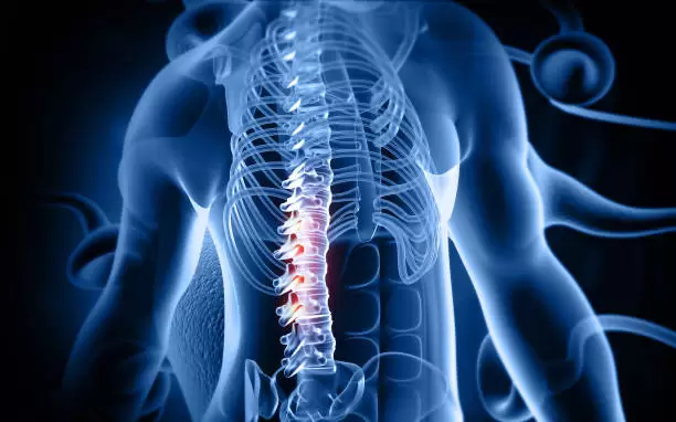Human back pain spine disc bulge stock photo
